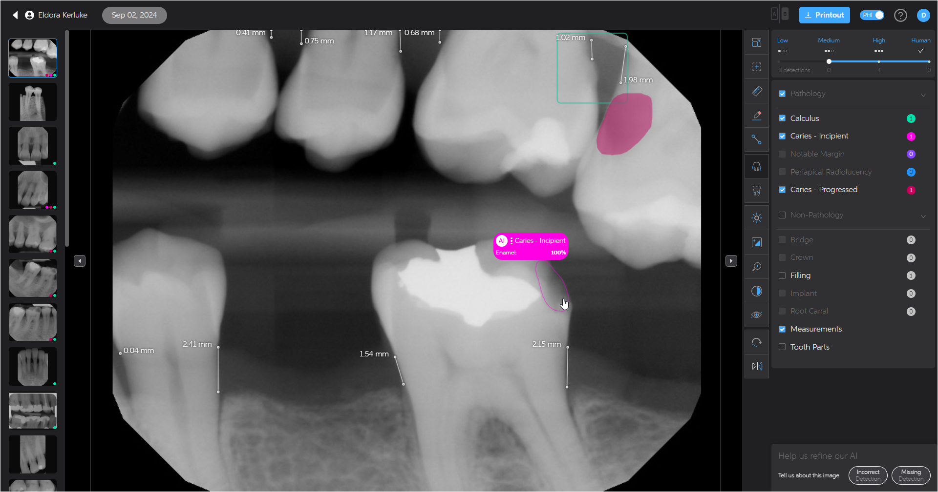 A screenshot of Second Opinion AI in EXACT